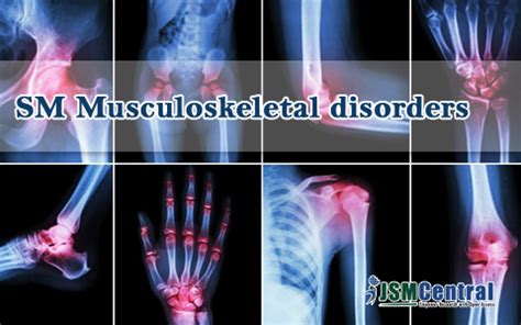 Archive - SM Musculoskeletal Disorders - JSMCentral