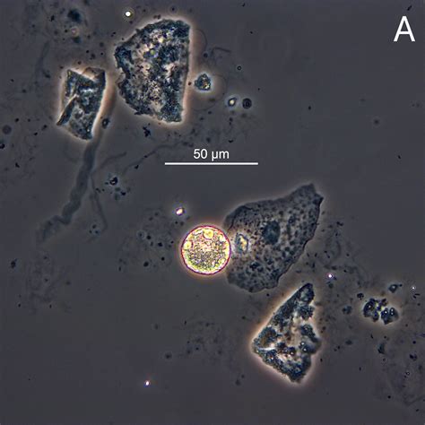 Urine Sediment Casts