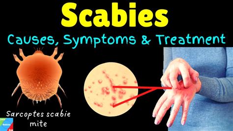 Scabies: Causes, Symptoms, Diagnosis, Treatment & Prevention - YouTube