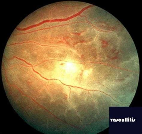 Fundus examination