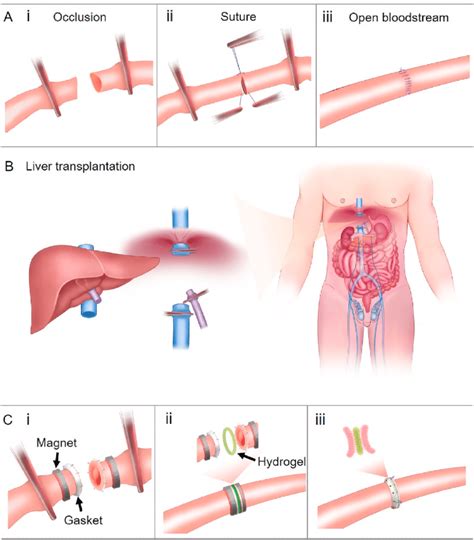 Vascular anastomosis during organ transplantation. (A) Anastomosis by ...