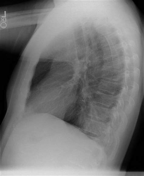 Pulmonary sequestration - wikidoc