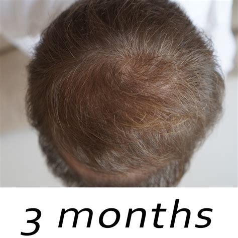 Topical Finasteride Before and After Results - Matt Dominance