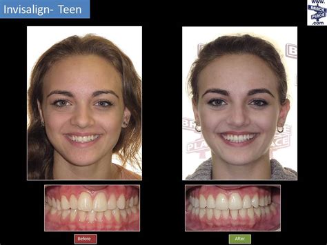 Invisalign® Before & After | Freehold Hightstown Manalapan NJ Orthodontist | Brace Place ...