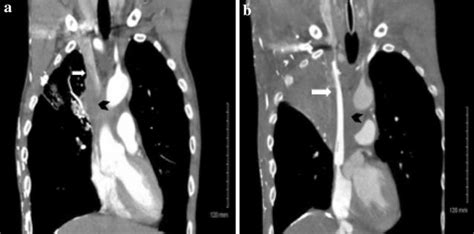 Stent placement for superior vena cava (SVC) syndrome. a Pre-stenting:... | Download Scientific ...