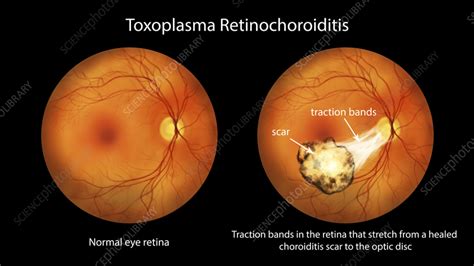 Toxoplasma retinochoroiditis, illustration - Stock Image - F040/4024 ...