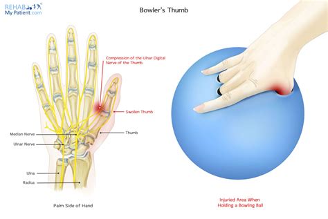 Bowler’s Thumb | Rehab My Patient