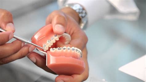 Braces: Broken Bracket, Poking Wire, Braces Pain - Aura Orthodontics - YouTube