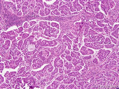 Papillary Adenocarcinoma of Lung - DoveMed