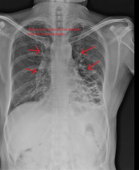 Bronchiectasis chest x ray - wikidoc