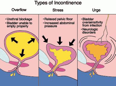 Urinary Incontinence Nursing Care Plan & Management - RNpedia