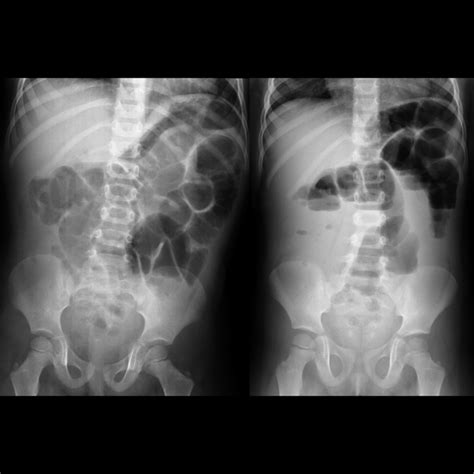 Preschooler with abdominal pain, diarrhea, emesis | Pediatric Radiology Case | Pediatric Imaging ...