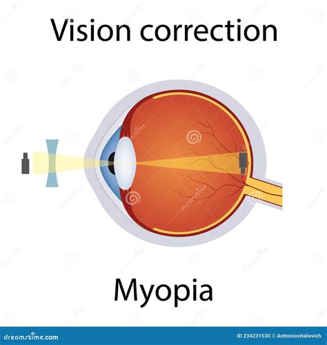 Myopia Corrected Cartoon Vector | CartoonDealer.com #52791027