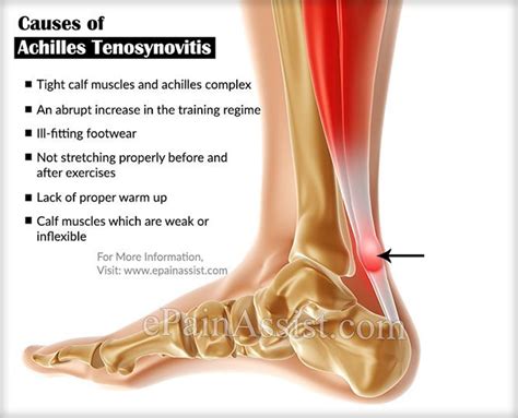 Bike Radar: What Causes Achilles Pain