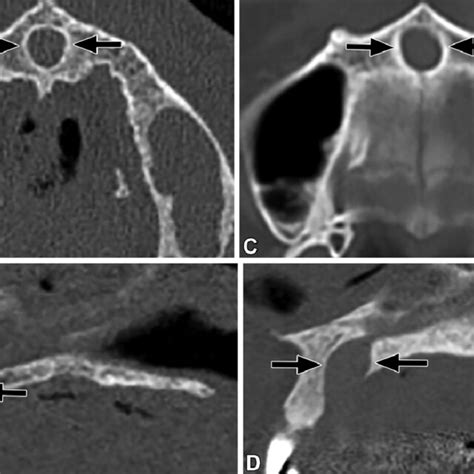 Cervical burnout versus dental caries. (A) Intraoral radiograph in a ...