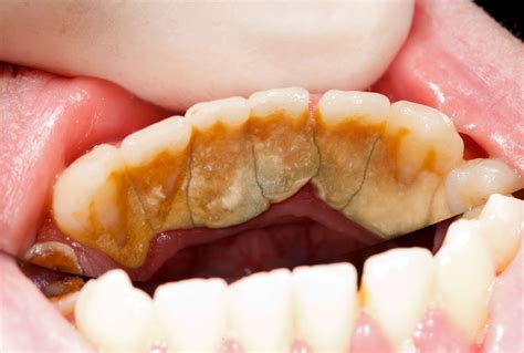 extensive dental plaque and tartar