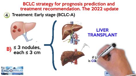 Barcelona Clinic Liver Cancer (BCLC) staging system. The 2022 update ...