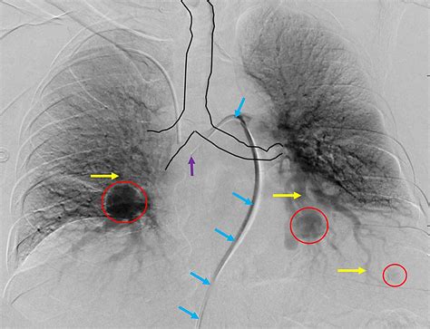 Cureus | Optimizing the Interventional Approach for Embolization of Pulmonary Arteriovenous ...