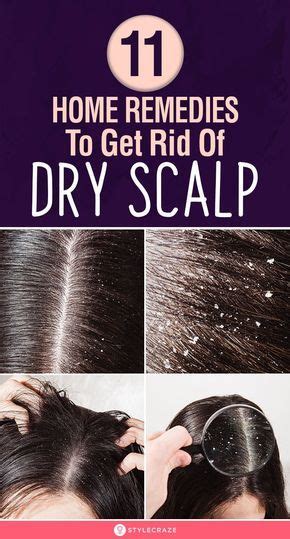 10 Best Home Remedies To Get Rid Of Dry Scalp | Dry scalp, Dry scalp ...