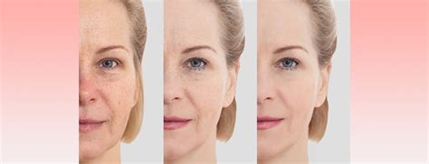 How Facial Rejuvenation Procedures Can Improve Aging Skin | Johns Hopkins Medicine