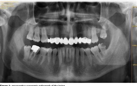 Calcifying Odontogenic Cyst Radiographic