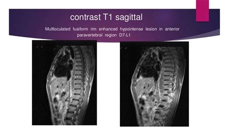 Intradural extramedullary mass - a case on MRI