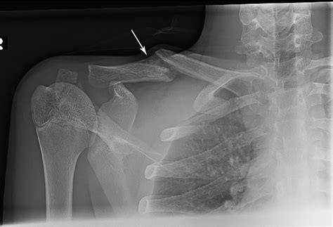 In pieces: Clavicle fracture | Radiology Key