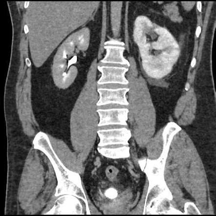 Obstructive uropathy with delayed nephrogram | Radiology Case ...