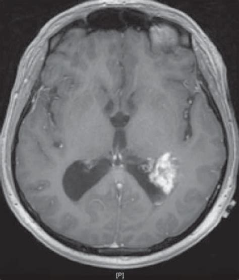 Solitary lesion within the atrium of the left lateral ventricle and ...