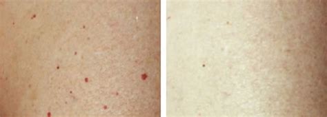 Red Mole (Cherry Angioma) Laser Removal