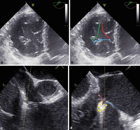 a-c Visualisation of tricuspid valve clipping by transoesophageal... | Download Scientific Diagram