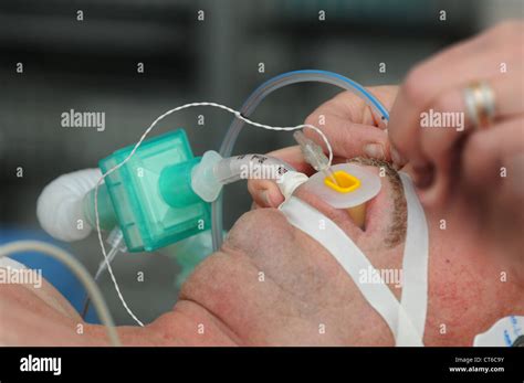 TRACHEAL INTUBATION Stock Photo - Alamy