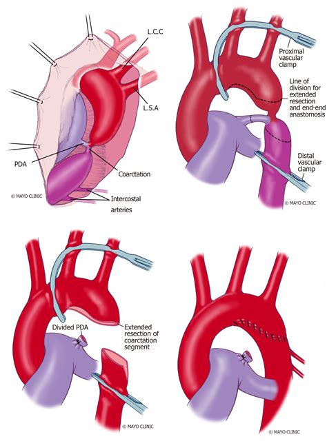 Coarctation Of Aorta Turner Syndrome - Captions Hunter