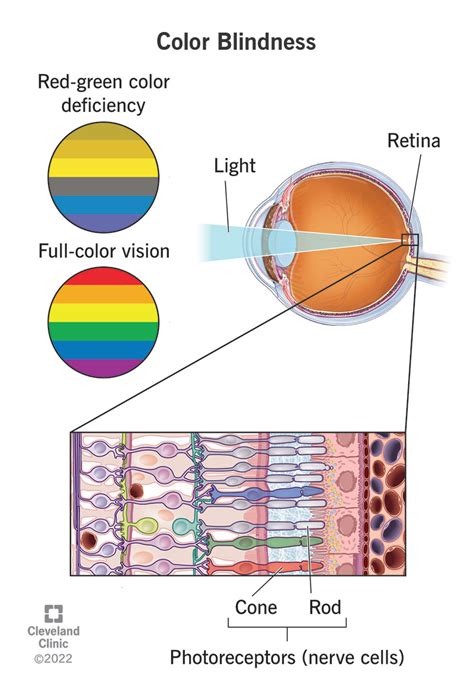 Color Blindness Types Causes Treatment 2508 | The Best Porn Website