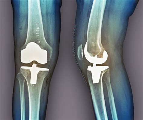 Partial vs. Total Knee Replacement Surgery