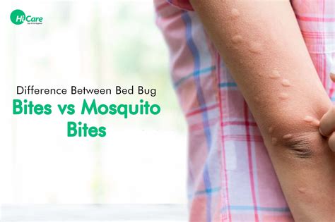 Difference between Bed Bug Bites and Mosquito Bites | HiCare