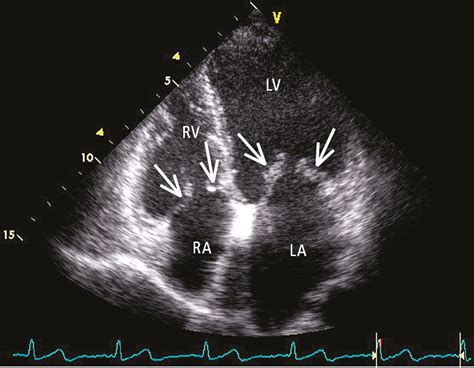 Figure 031_6396. Transthoracic echocardiography (TTE; apical 4-chamber ...