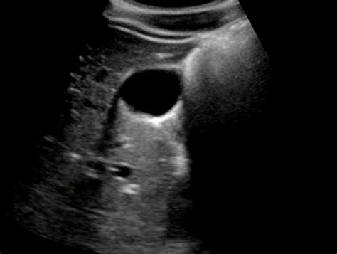 Ultrasound Artifacts for Beginners – Critical Care Transport at Michigan