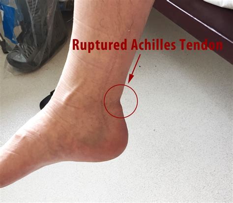 Achilles Tendon Rupture Non-Surgical Recovery and Proper Rehab - The First 6 Weeks - Ian Lee ...