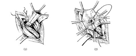 原位腹股沟斜疝修复术-手术图解,_医学图库