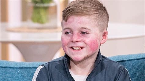 The brave boy living with rare skin disease epidermolysis bullosa | This Morning