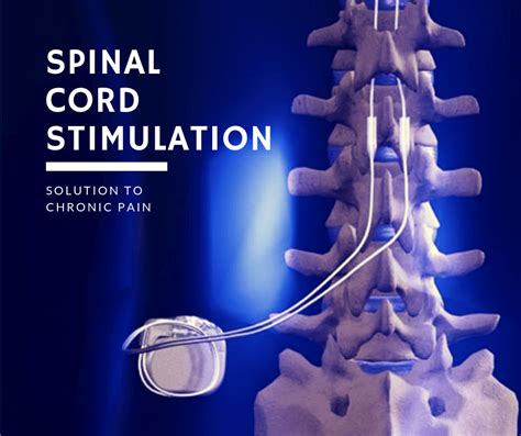 Spinal Cord Stimulation - Amara Pain & Spine Management