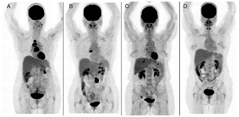 Staging recurrent ovarian cancer with 18FDG PET/CT