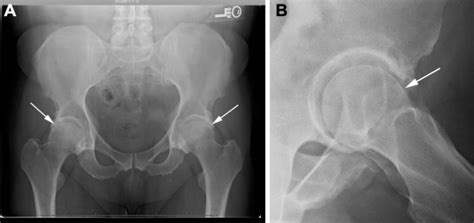 Management of Incarcerating Pincer-Type Femoroacetabular Impingement With Hip Arthroscopy ...