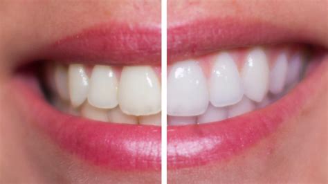 Hydrogen Peroxide Teeth Whitening - ToothStars