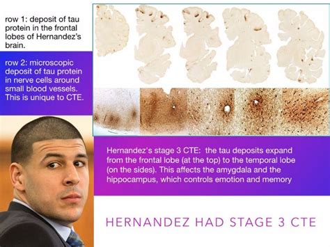 Aaron Hernandez - CTE Brain Injury - Murder Defenses - Criminal Law ...