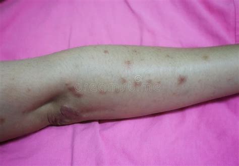 Close-up of the Skin on the Arm of Women with Skin Diseases, Allergies, Rash, Redness, Itching ...