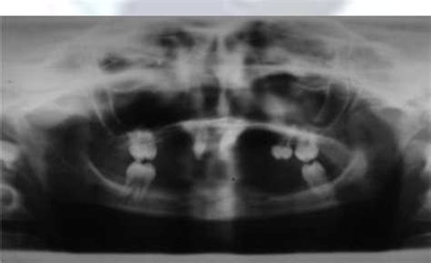 [PDF] Anhidrotic Ectodermal Dysplasia : The Dental Perspective : A Case Report | Semantic Scholar