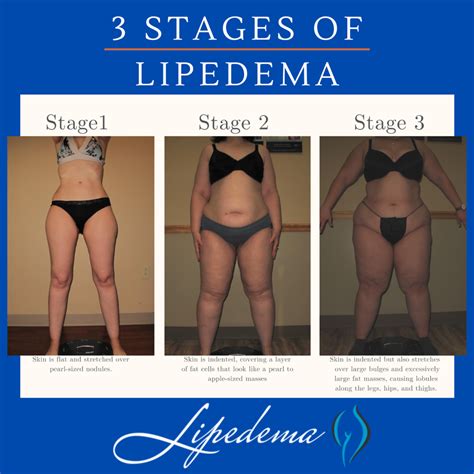 Remedies Lipedema Diet Stage