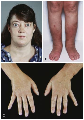 Pretibial Myxedema Graves Disease